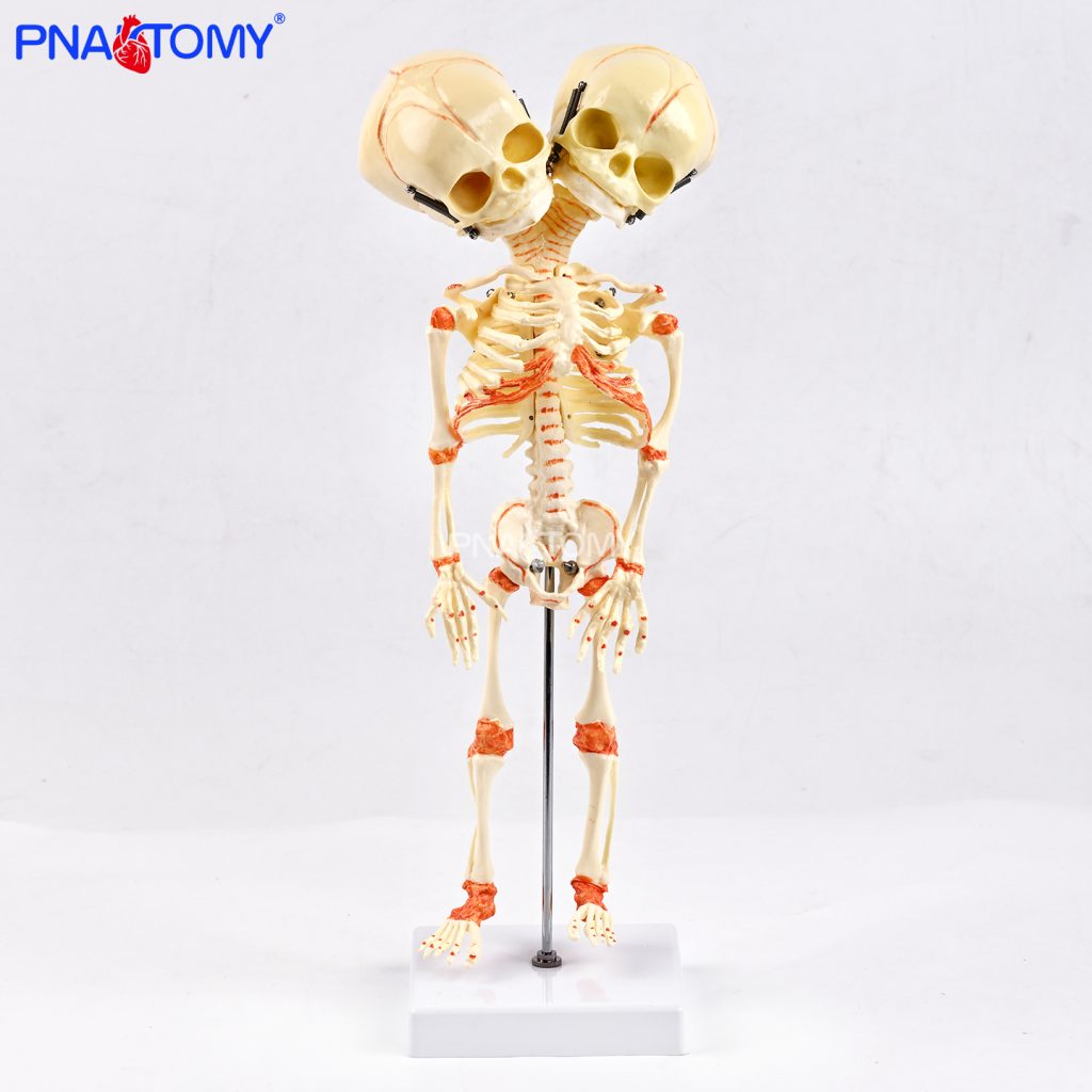 Two-headed baby bones.