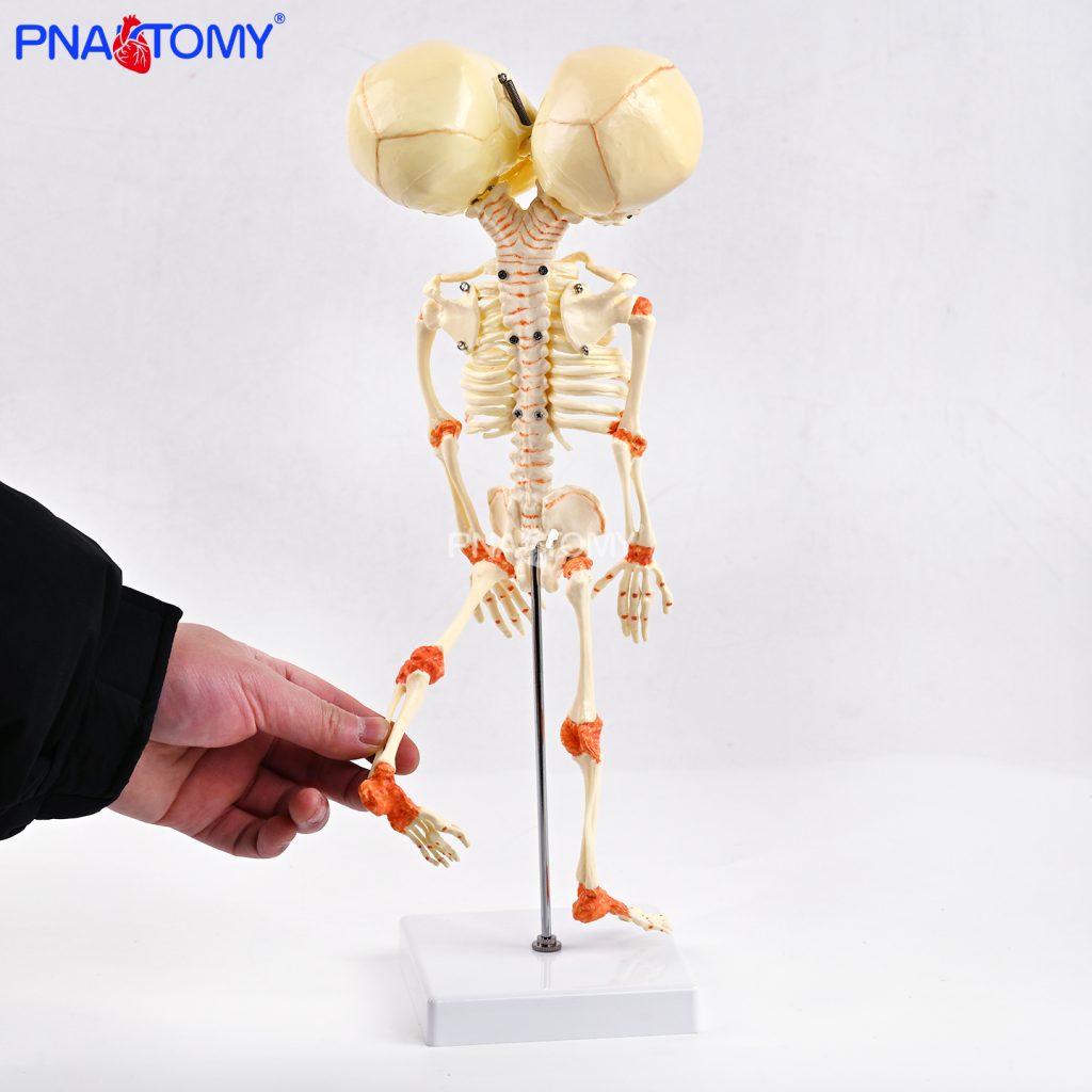 Two-headed baby bones.