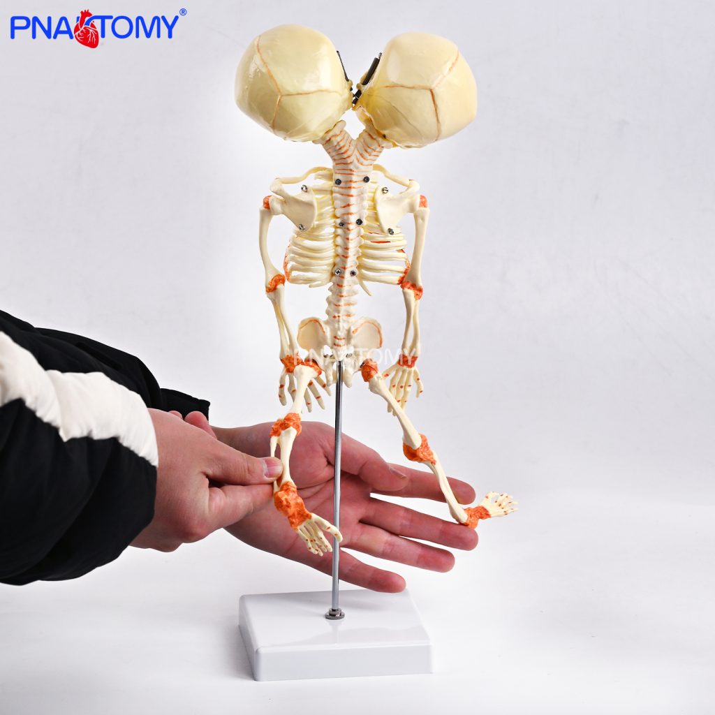 Two-headed baby bones.