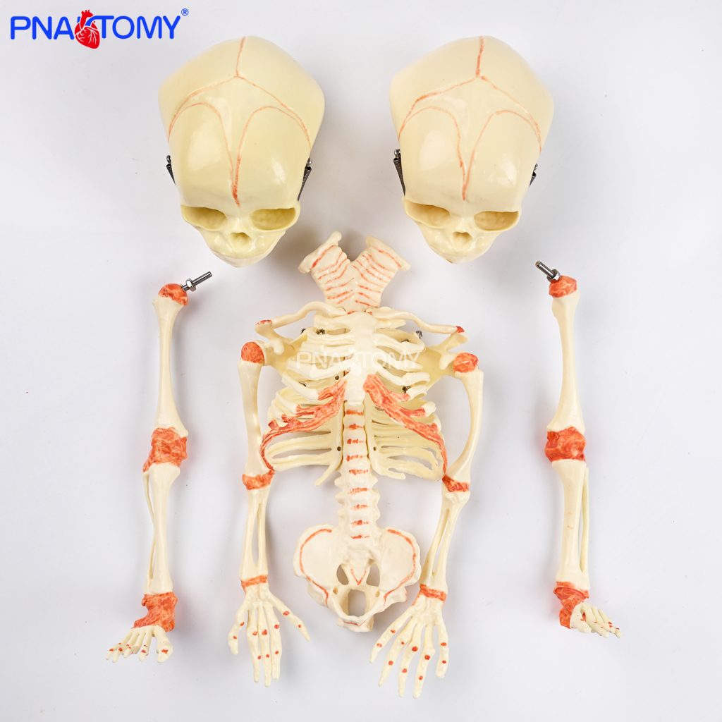 Two-headed baby bones.