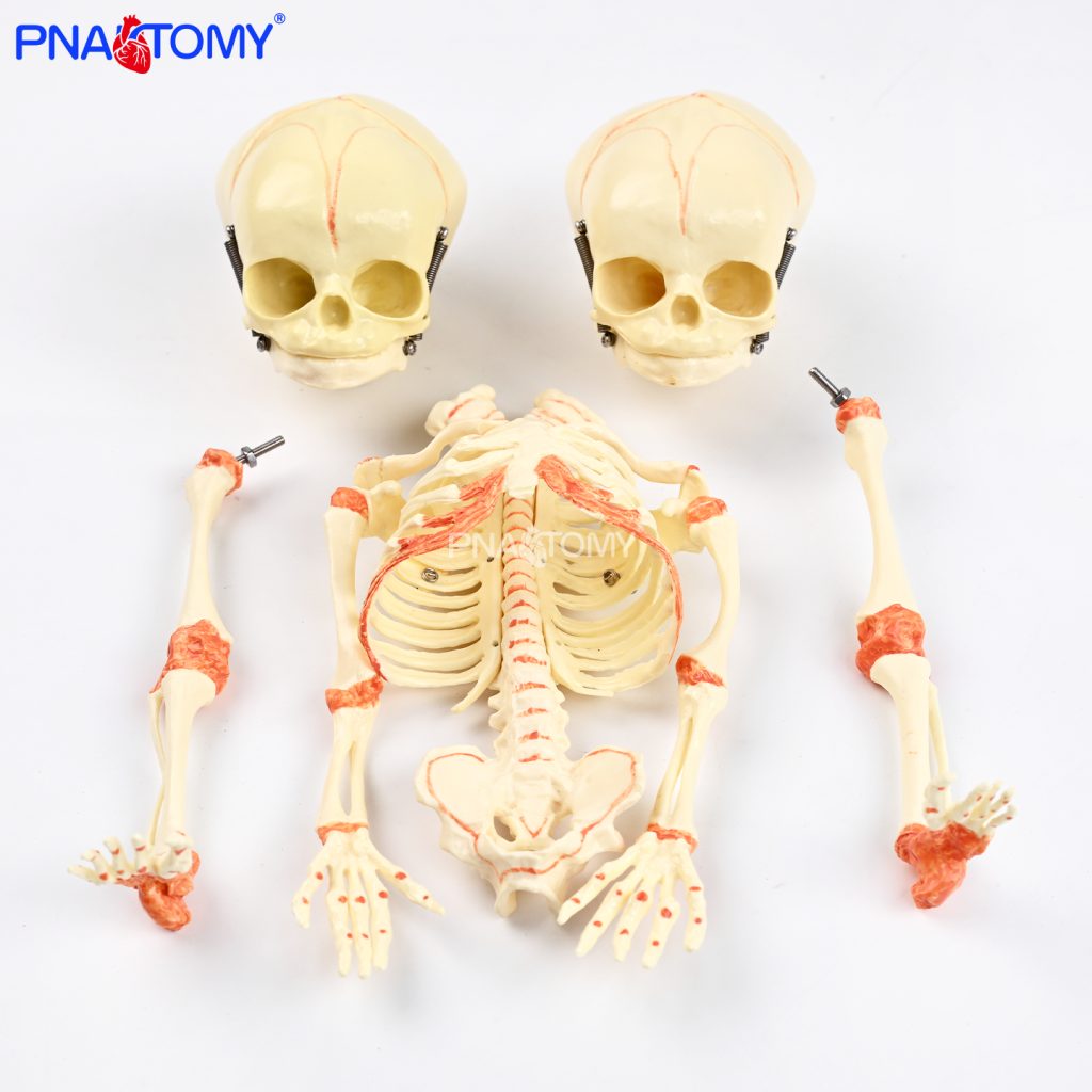 Two-headed baby bones.