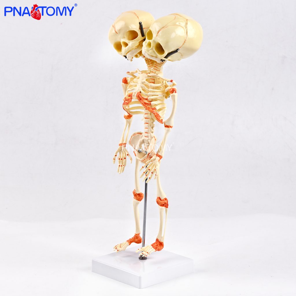 Two-headed baby bones.