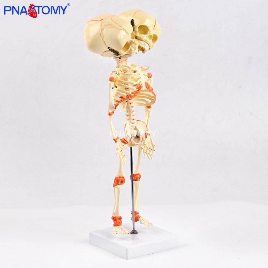 Two-headed baby bones.